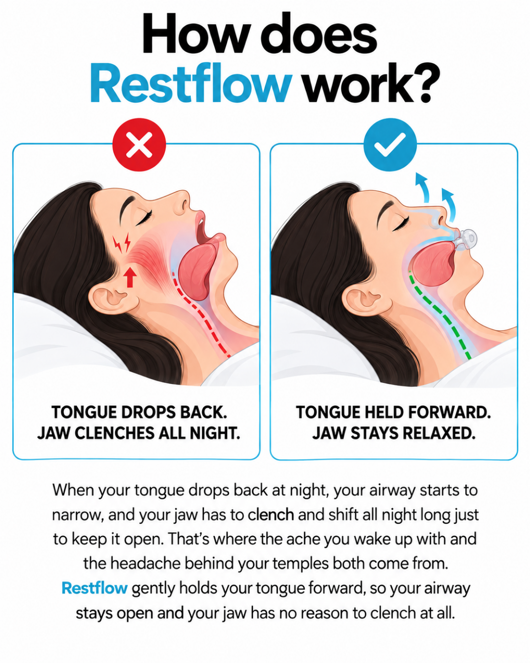 Restflow Tongue Positioning Retainer
